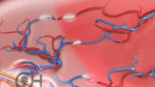 Treatment Options TwinTwin Transfusion Syndrome TTTS 5 of 9 [upl. by Enilarak]