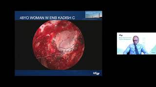 Surgical Management of Meningiomas and Other Skull Base Tumors  Philip Theodosopoulos MD [upl. by Letsyrc651]