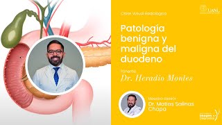 Patología benigna y maligna del duodeno por el Dr Heradio Montes [upl. by Zel428]