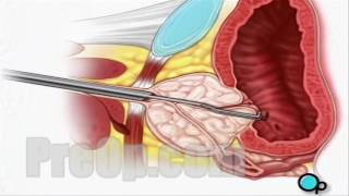 TURP Transurethral Resection Prostate Surgery patient education series [upl. by Lisha]