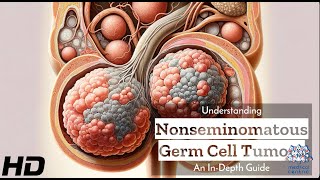 Nonseminomatous Germ Cell Tumors Explained What You Need to Know [upl. by Wiebmer188]