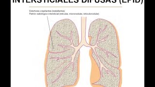 FISIOPATOLOGÍA RESPIRATORIA Enfermedades pulmonares intersticiales difusas EPID [upl. by Swaine]