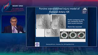 Atherectomy for Restenosis Future of Combination Therapy [upl. by Weingartner]