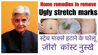 How to remove stretch markshome remedy to cure stretch marksस्ट्रेच मार्क्स हटाने के घरेलू नुस्खे [upl. by Sotsirhc]