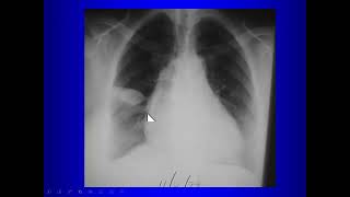 Abnormalities on Thoracic Radiography for Medical Students [upl. by Ennairda]