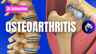 Understand Osteoarthritis  OA of the Knee Spine Hip Hand Elbow and more [upl. by Johan469]