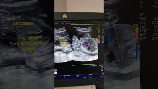 Fetal Echogenic Intracardiac Focus Ultrasound [upl. by Lehet]