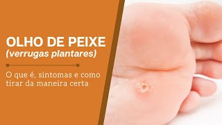 Olho de peixeverrugas plantares o que é sintomas e como tirar da maneira certa [upl. by Retse]