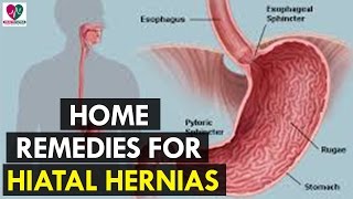 Home Remedies for Hiatal Hernias  Health Sutra [upl. by Fillender]