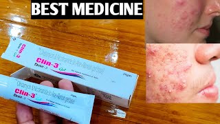 Clin 3 Gel Unboxing amp Review  चेहरा साफ करने और मुंहासे हटाने की Best दवा  Best Cream for Pimple [upl. by Evania908]