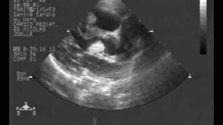 echocardiogram multiple rhabdomyoma tumorLong axis view [upl. by Bibeau]