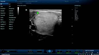 4th tirads score thyroid nodule Diagnostic ultrasound cases [upl. by Eladnwahs]