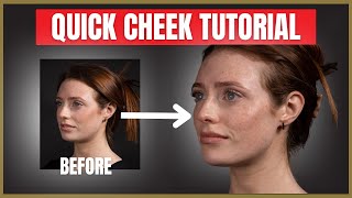 Quick Cheek Filler Tutorial  Cheek Dermal Filler Injection Advice [upl. by Dietrich86]