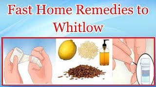 Fast Home Remedies to Whitlow [upl. by Egin]