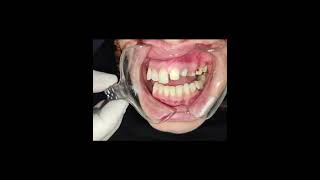 fixedteeth  bestdentistinpeshawar  viralshorts2024  DrFaisalMansoorviraldentist [upl. by Iaj]