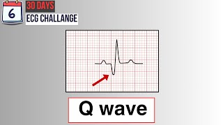 Day 6 Pathological Q waves on ECG  30Day ECG challenge [upl. by Zohara816]