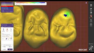 2 anatomic bridge dental software [upl. by Lorna]