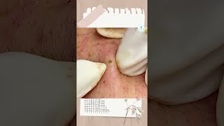 Big Cystic Acne Blackheads Extraction Blackheads amp Milia Whiteheads Removal Pimple Popping shorts [upl. by Aynekal]