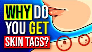 What You Need To Know About SKIN TAGS and How To Remove Them [upl. by Aicercul3]