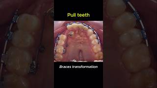 Braces change your teeth for better braces orthodontist dentist [upl. by Amliv430]