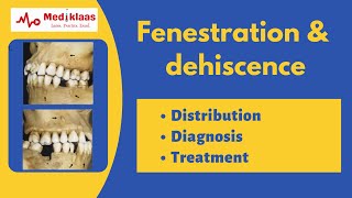 Fenestration and Dehiscence l Periodontal anatomy l Mediklaas [upl. by Eyot]