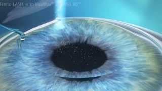 Cirurgia Refrativa a Laser Lasik para Miopia Astigmatismo e Hipermetropia [upl. by Gravante]