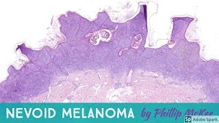 Nevoid melanoma explained by Dr Phillip McKee [upl. by Nrehtac]