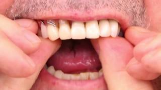 Partial Denture Video [upl. by Beryle396]