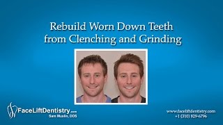 Rebuild Worn Down Teeth from Clenching and Grinding [upl. by Colbert]