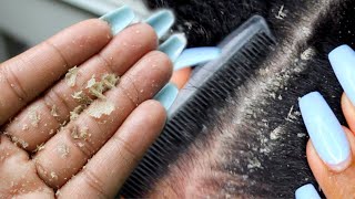 BIG FLAKES Scalp scratching and picking  Satisfying Dandruff Removal ASMR [upl. by Ciro]