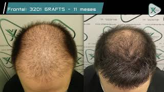 Trasplante Capilar FUE  Hair Trasplant  Dra Ximena Vila  5702 Grafts [upl. by Alvar]