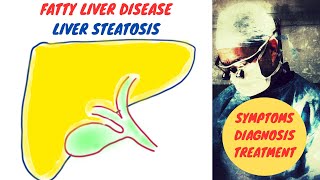 Fatty Liver Disease  Liver Steatosis [upl. by Eelyma261]