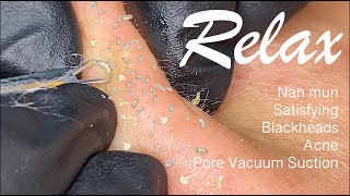 ☘️ Nặn mụn 🌸 Relax Satisfying Blackheads Acne Pore Vacuum Suction 28 [upl. by Lawrence]