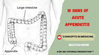 10 Signs Of Acute Appendicitis Made So Easy [upl. by Cordova115]