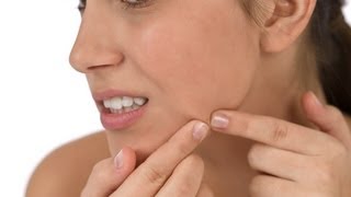 Treatment Options for Cystic Acne  Acne Treatment [upl. by Amsa]