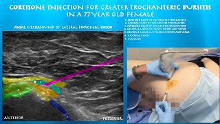 Ultrasound Guided Greater Trochanteric Bursitis Injection by probeultrasound [upl. by Cadmarr503]