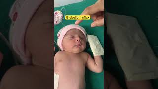 Reflex examination physiology  palmar reflex in newborn  Glabellar reflex in newborn  youtube [upl. by Airolg346]