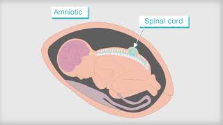 What is Spina Bifida [upl. by Ashli]