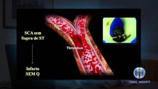 Infarto Agudo no Miocárdio  Fisiopatologia I 210 [upl. by Ahtelahs]