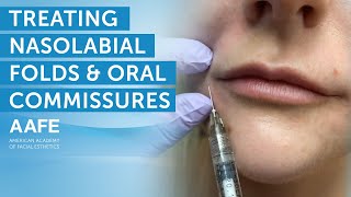 Using Dermal Fillers to Fill and Smooth Smile Lines  AAFE [upl. by Novel]