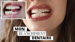 BLANCHIMENT DENTAIRE  chez le dentiste  prix durée etc JE VOUS DIS TOUT [upl. by Halilad838]