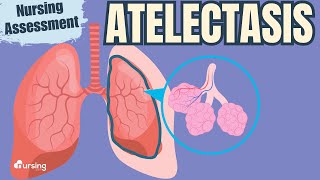 Atelectasis Pathophysiology and Nursing Assessment [upl. by Caril]