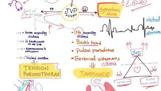 Shock in the setting of a trauma patient Hypovolemic shock Tension Pneumothorax or tamponade [upl. by Walburga894]