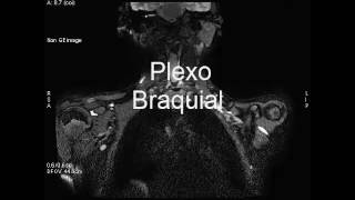 Plexo braquial [upl. by Edasalof413]