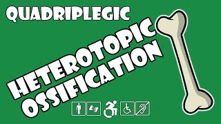 Heterotopic Ossification HO Explained  Quadriplegic C5C6C7 [upl. by Arvad803]