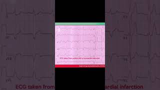 Left bundle branch block LBBB ECG Example 9 [upl. by Elokin]