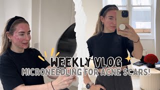 MICRONEEDLING FOR ACNE SCARS  DECLUTTERING  Weekly Vlog [upl. by Otilegna]