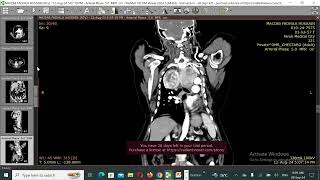 Carcinoid tumor of the lung [upl. by Emersen]