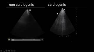 Great role of US in diffrentiating between cardiogenic and non cardiogenic pul edema [upl. by Macy549]