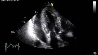 TAMPONADE LEFT VENTRICULAR DIASTOLIC COLLAPSE [upl. by Ziana349]